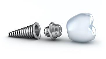 dental implant west bradenton fl