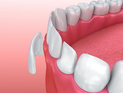veneers in bradenton fl