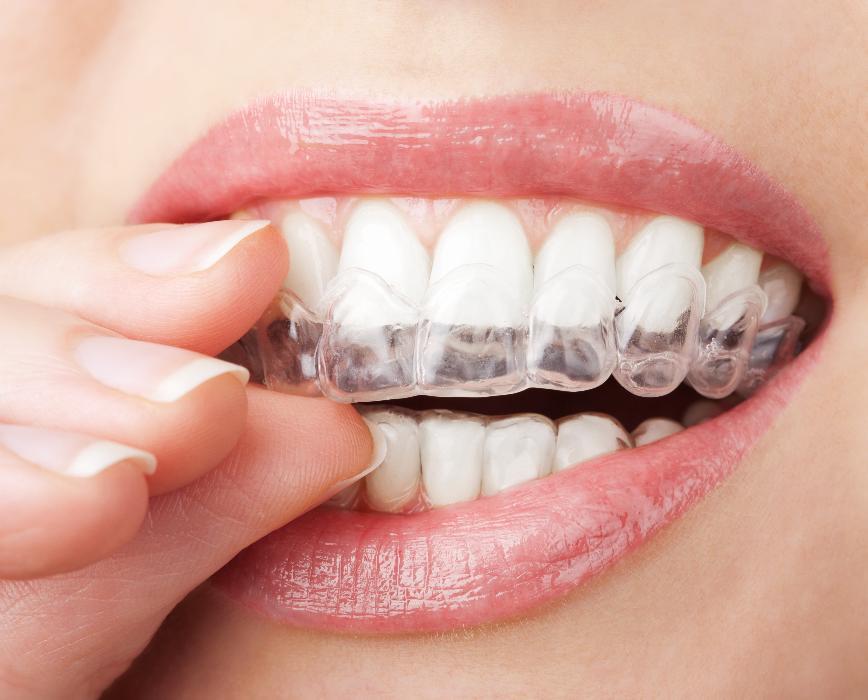 Invisalign in bradenton fl