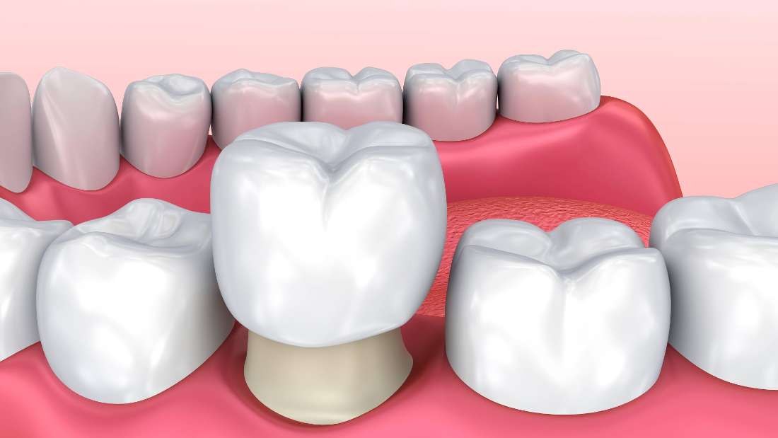 Resin Veneers vs. Porcelain Veneers? Dentist in Bradenton FL
