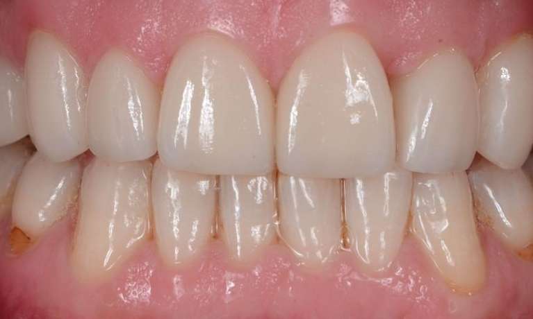 dental implants in west bradenton fl