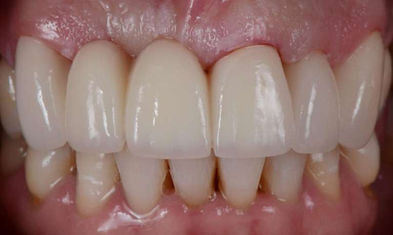 Cosmetic-Fixed-Bridge-After-Image