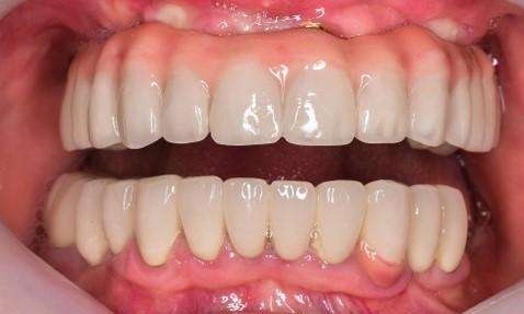 Non-removable-Zirconia-Bridge-Supported-by-Implants-After-Image