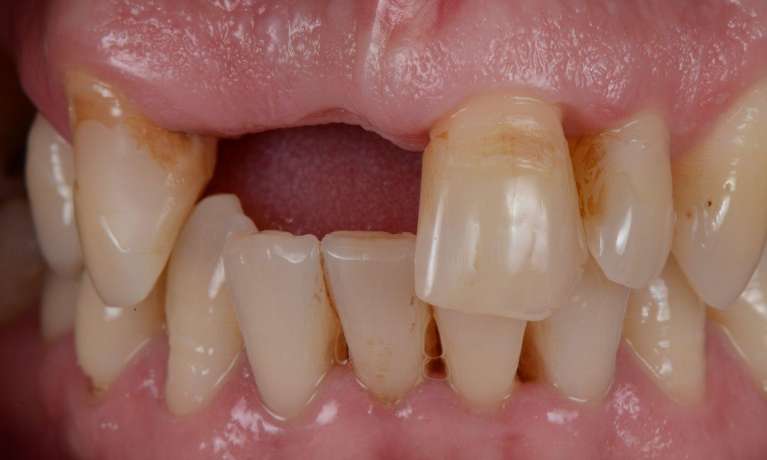 Cosmetic-Fixed-Bridge-Before-Image