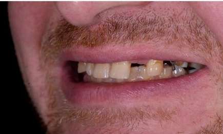 missing tooth bradenton fl
