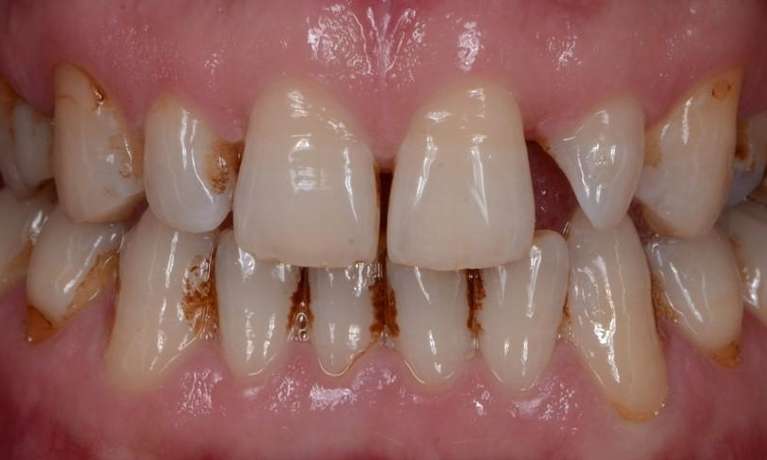 dental crowns bradenton fl