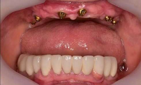 Non-removable-Zirconia-Bridge-Supported-by-Implants-Before-Image