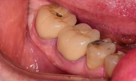 metal free crowns bradenton fl