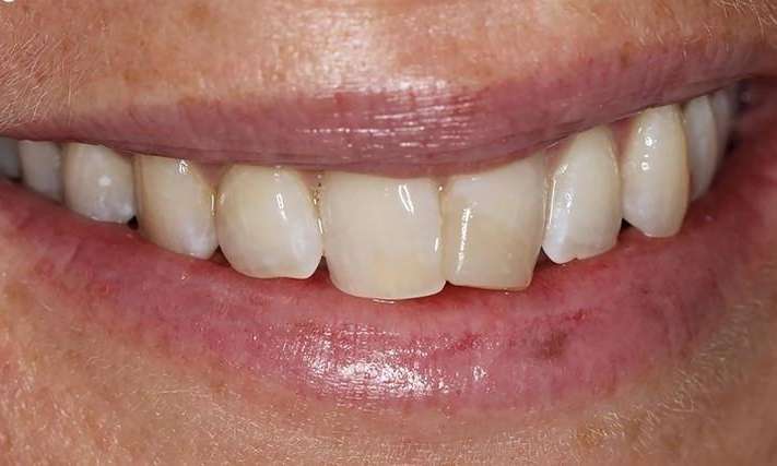 smile makeover bradenton fl